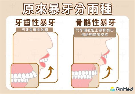 暴牙面相